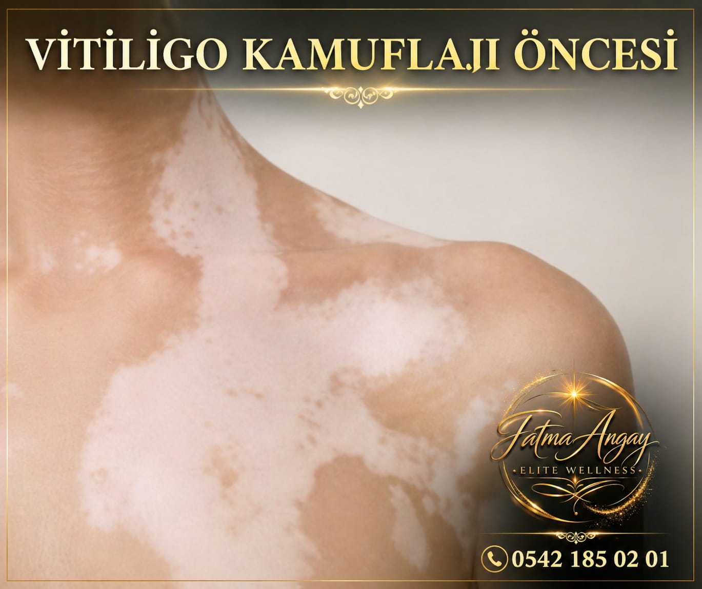 Vitiligo Kamuflaj